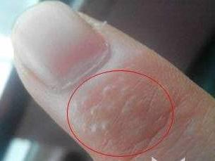 手上长这种小水泡 是身体在给你发信号 要注意了