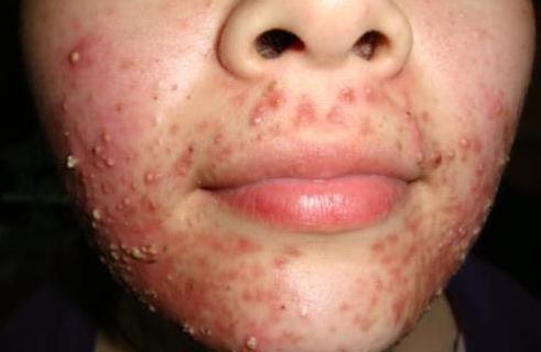 导致脸上出现皮屑,瘙痒,色斑,面部油光,皮肤粗糙,毛囊炎或痘痘粉刺等