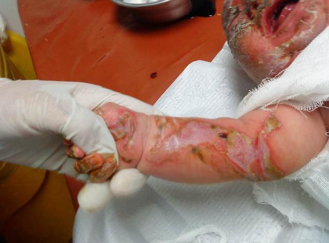 宝宝被骨头汤大面积烫伤,爸爸的决定让妈妈哭了