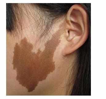 身体出现这3种症状 多半是体内癌细胞要苏醒了|咖啡斑|癌细胞|纤维瘤