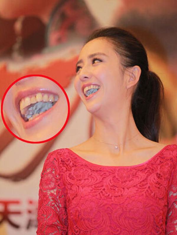 佟丽娅出席活动捞金开口大笑满口黄牙辣眼睛口中白色异物引争议
