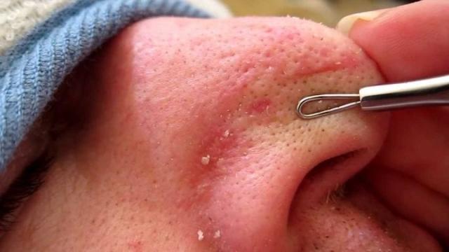 有时候一挤,就会出现一些白色的小颗粒,粘粘的,看起来像芝麻粒一样.