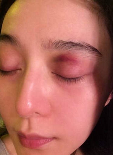 不用替身受伤的女明星,柳岩膝盖破皮,范冰冰眼睛受伤!她才最惨