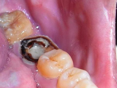 2岁孩子没让他吃过糖, 一口烂牙, 牙医指责妈妈的无知