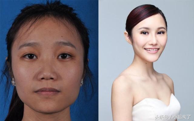 10名女孩整容前后的对比照,看完都不敢相信自己的眼睛
