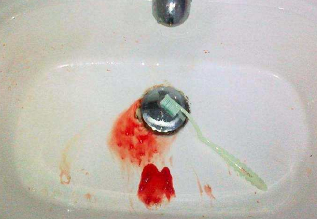 鼻咽癌早期表现为鼻涕中带血或吸鼻后痰中带血,常发生在早晨起床后,从