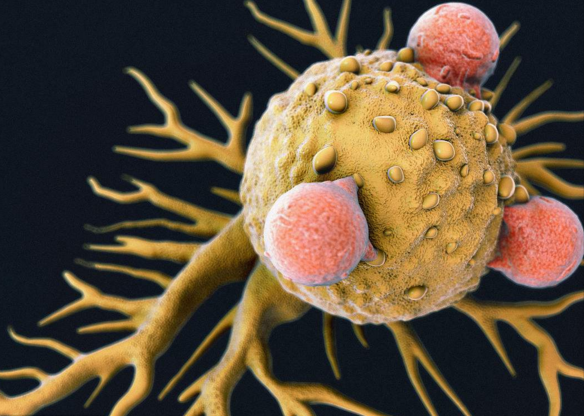 显微镜下,免疫细胞是如何逮捕癌细胞的