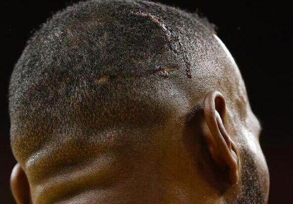 詹姆斯:2015年总决赛头上留下的伤口没愈合好