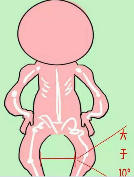 把宝宝害成o型腿,原因是妈妈对宝宝做了这种事.