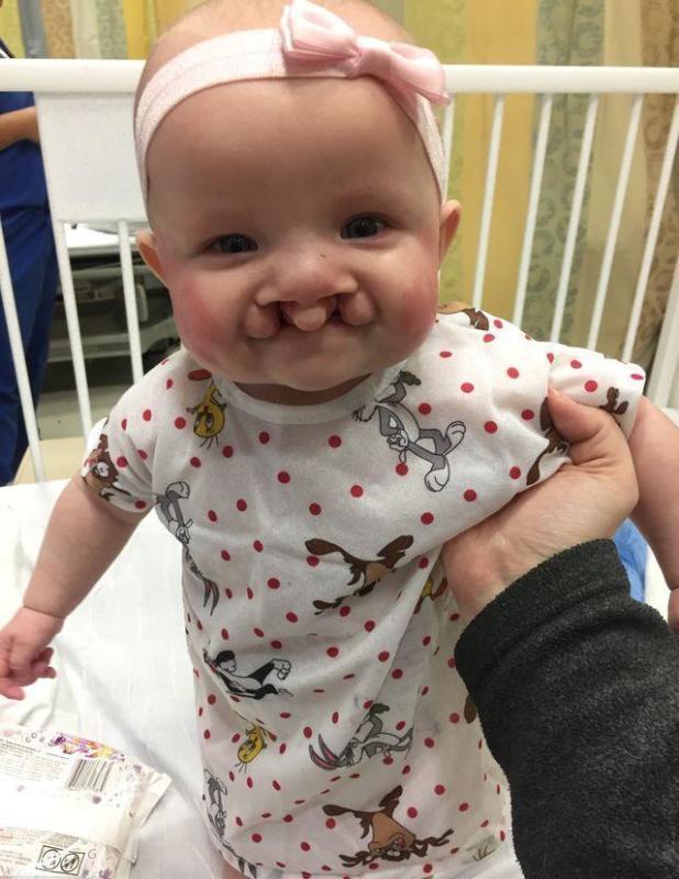 "兔唇"宝宝2周大接受手术治疗,拆线后妈妈泣不成声