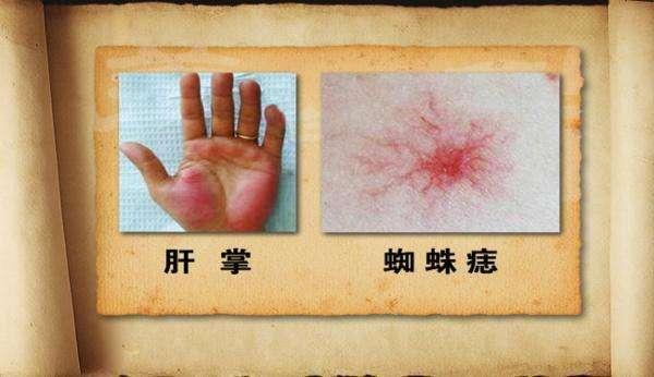 1,出现蜘蛛痔和肝掌手掌大,小鱼际显著充血称肝掌.