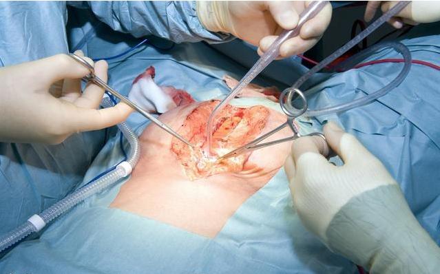 我的家庭噩梦一样,尿毒症还没来得及治疗,却又查出卵巢癌