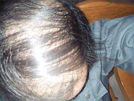 头痒头油还能扣下小颗粒,有这4症状,一个毛囊