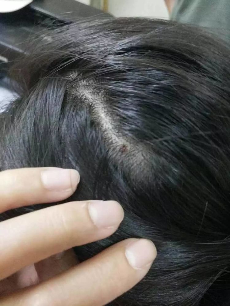 爸妈天天给孩子洗头,却没发现孩子头皮上长虫子,得知后怕不已!