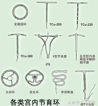 这些危害对身体也太大了|上环|避孕|子宫_新浪新闻