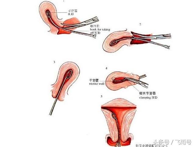 上环真的好吗这些危害对身体也太大了