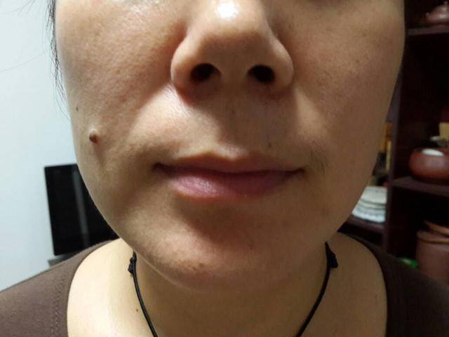 脸上为什么长痦子提前预防吧