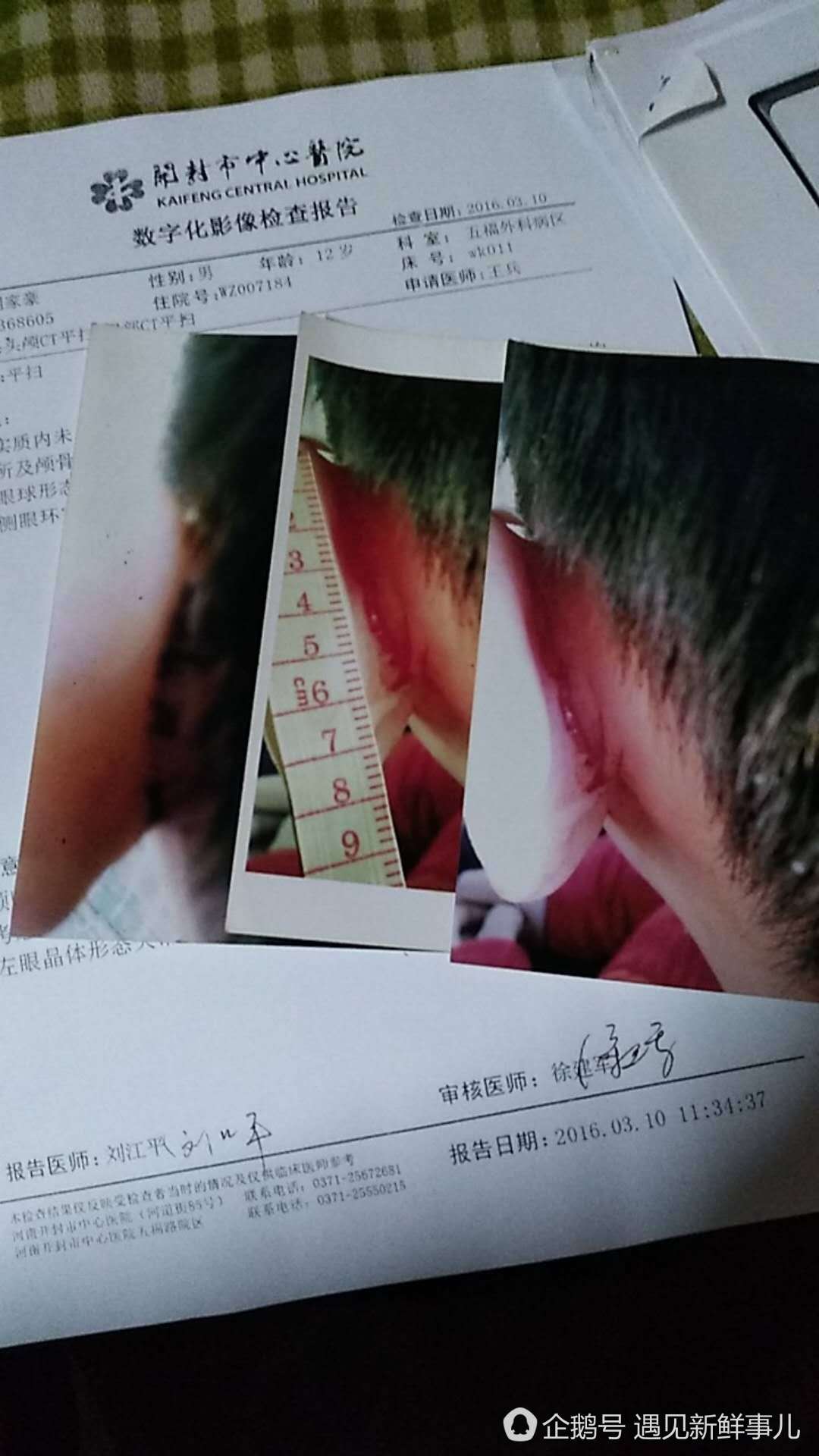 河南开封一学生耳朵被老师撕烂缝7针
