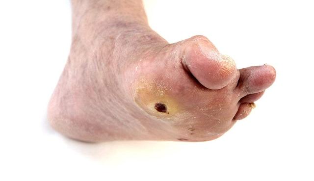 糖尿病日糖尿病足溃疡应注意什么为家人收藏着