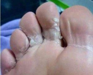 中医又称湿脚气,脚气疮,俗称烂脚丫.