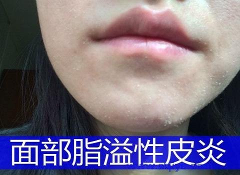 脂溢性皮炎会不会传染?你所不得不知的