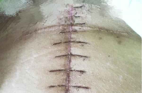 剖腹产生了二胎,肚子上一个十字架的疤真心觉得难看