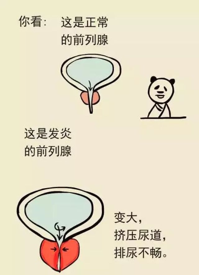 【健康】前列腺炎症、增生会变癌症吗?“男性生命线”这样保养!|前列腺增生|前列腺癌|小张_新浪新闻