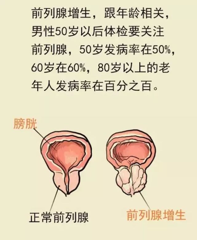 【健康】前列腺炎症、增生会变癌症吗?“男性生命线”这样保养!|前列腺增生|前列腺癌|小张_新浪新闻