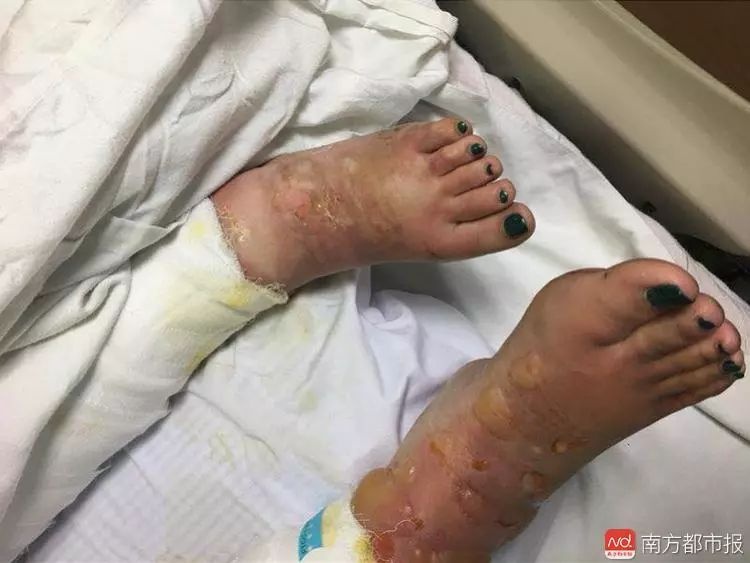 24岁女孩重度烧伤病情危重,母亲赴粤途中车祸身亡