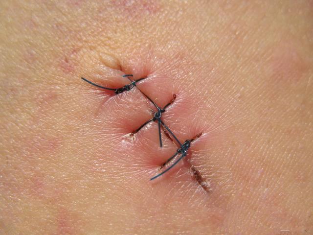 顺产时你被侧切了么?关于侧切这件事,终于有产科大夫说真话了