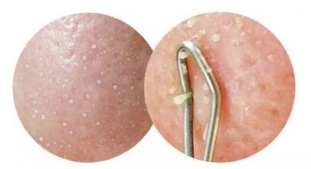 脸上有小疙瘩,能挤出白色条状物,到底. 来自Sn