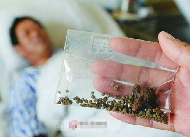 2天排出肾结石 新浪（移动端）