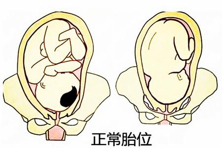 胎位不正,只能选择剖腹产吗?|胎位|胎儿|怀孕_新浪新闻