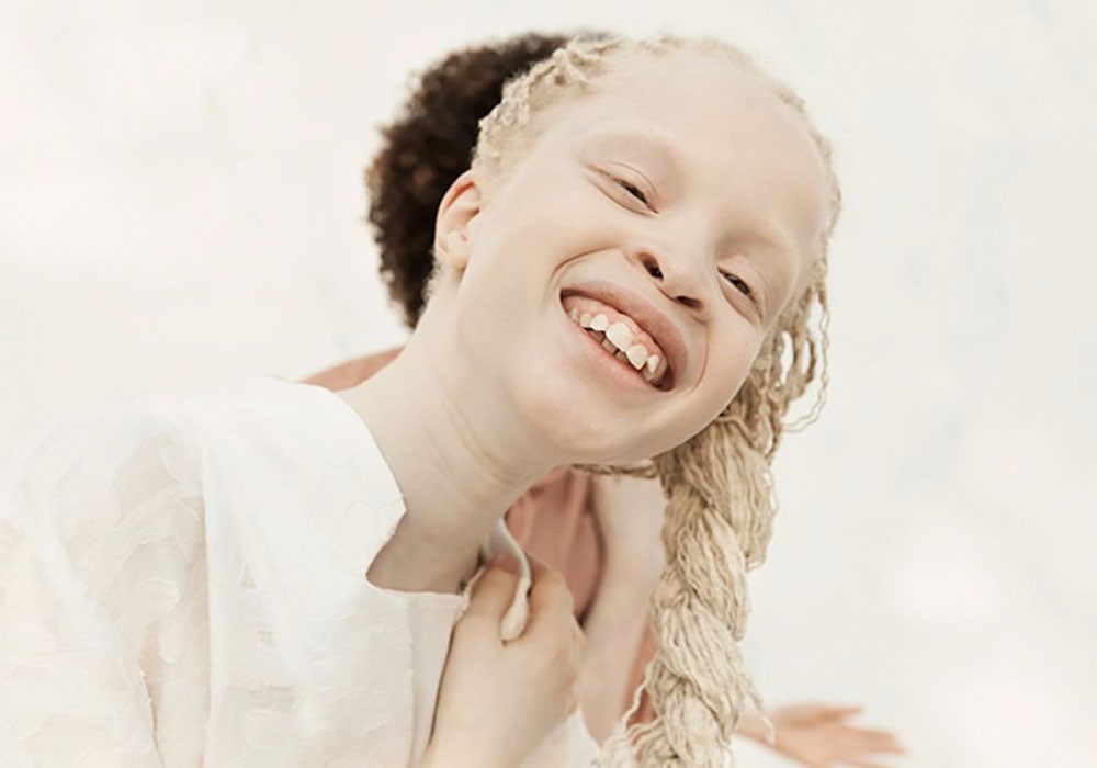 11岁黑人白化病双胞胎曾被嘲笑,这组照片后她们横扫时尚圈!