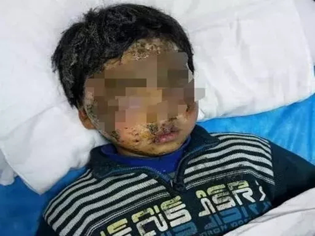 家长留心,元宵放炮仗,多娃炸伤,有的脸都炸烂!