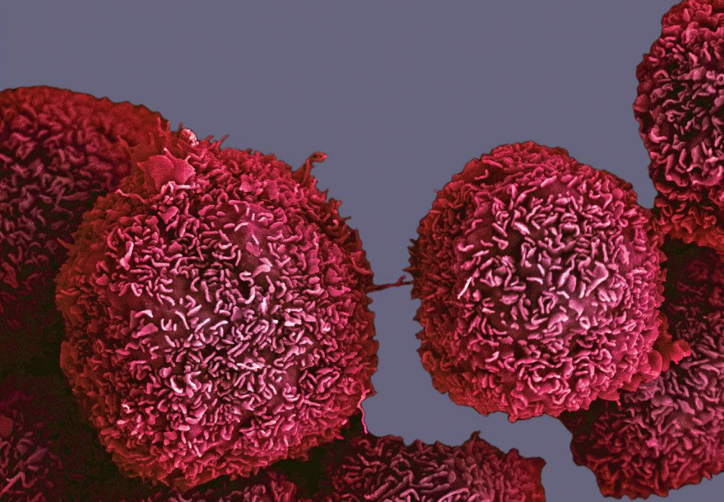 科学家发现癌细胞软肋,稍动手脚就可令其自杀