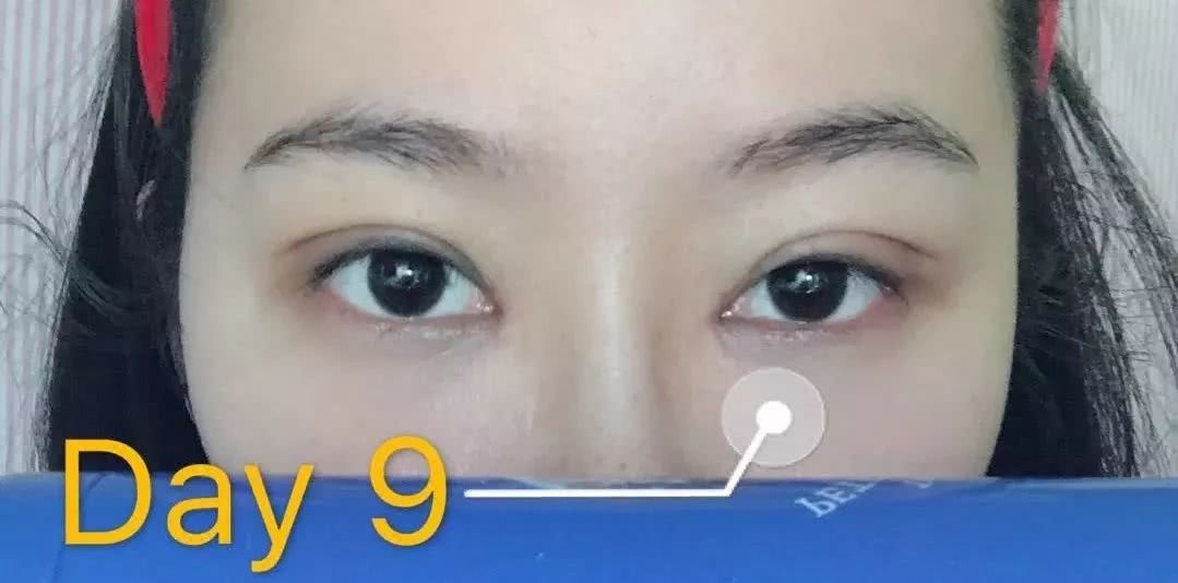 死鱼眼单身姑娘趁假期割了双眼皮,瞬间变电眼,好看死了!