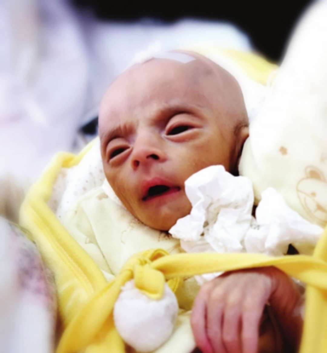 贵州"外星人"宝宝会走路了,曾经全城的爱心妈妈送母乳救他