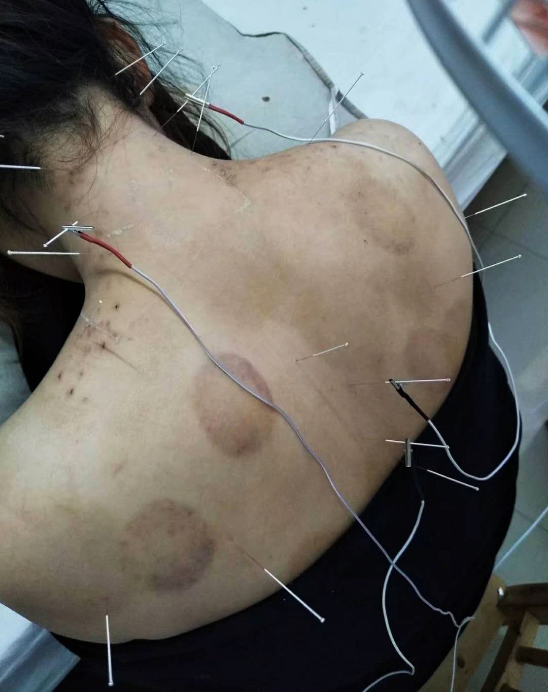 治疗,病情都没有明显好转,后来经人介绍在民间诊所用刺血拔罐治疗一年