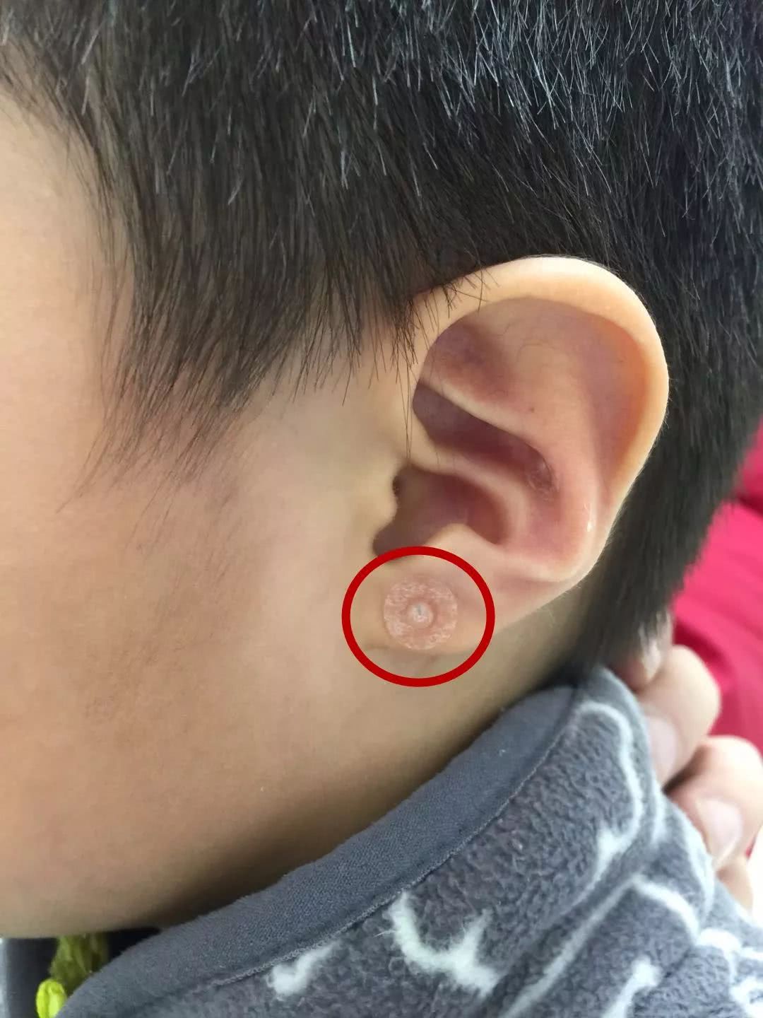 妇儿医院中医科联合眼科开展皮内针治疗儿童假性近视