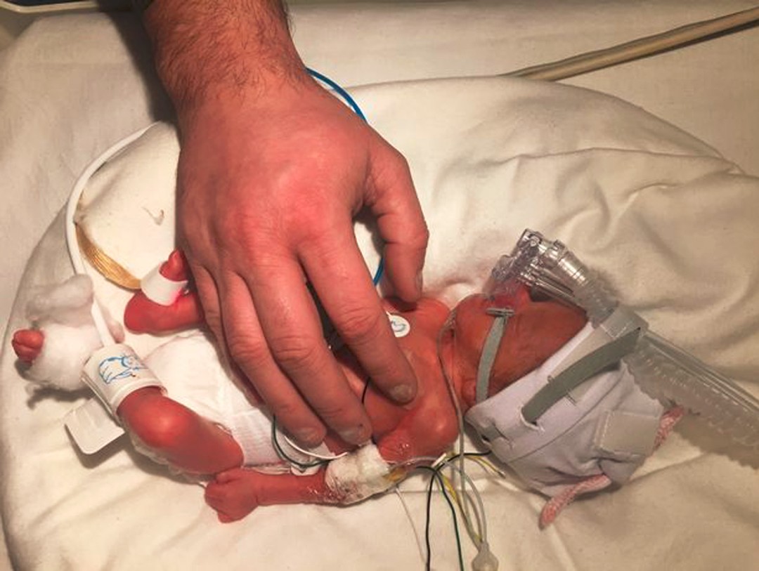 早产女婴出生时只有父亲手掌大,都以为活不成如今1岁多了