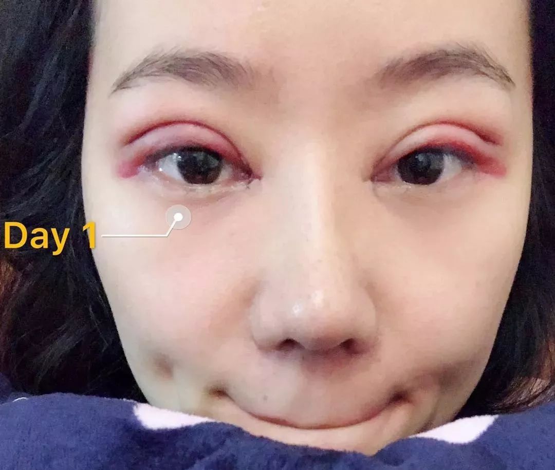 死鱼眼单身姑娘趁假期割了双眼皮,瞬间变电眼,好看死了!