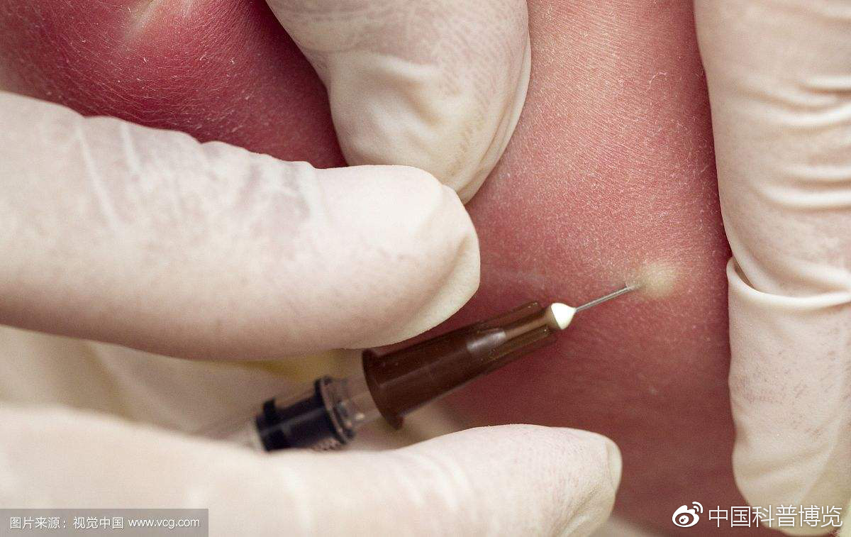 结核病防治疫苗——卡介苗