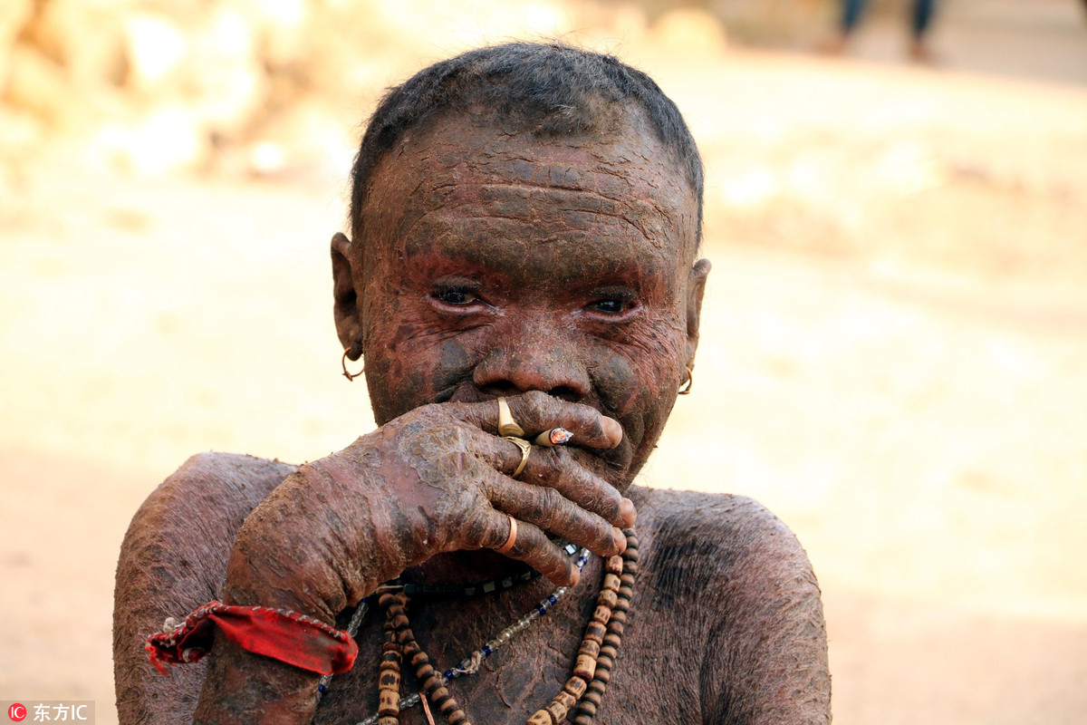 印度男子患红皮病成"蛇人" 每10天蜕皮一次触目惊心