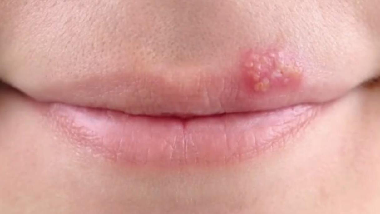 嘴唇长泡切勿忽视,或许是这种病!