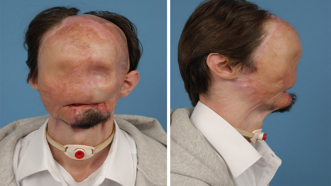 现实版无脸男!整张脸除了嘴巴,其他器官全都没有!