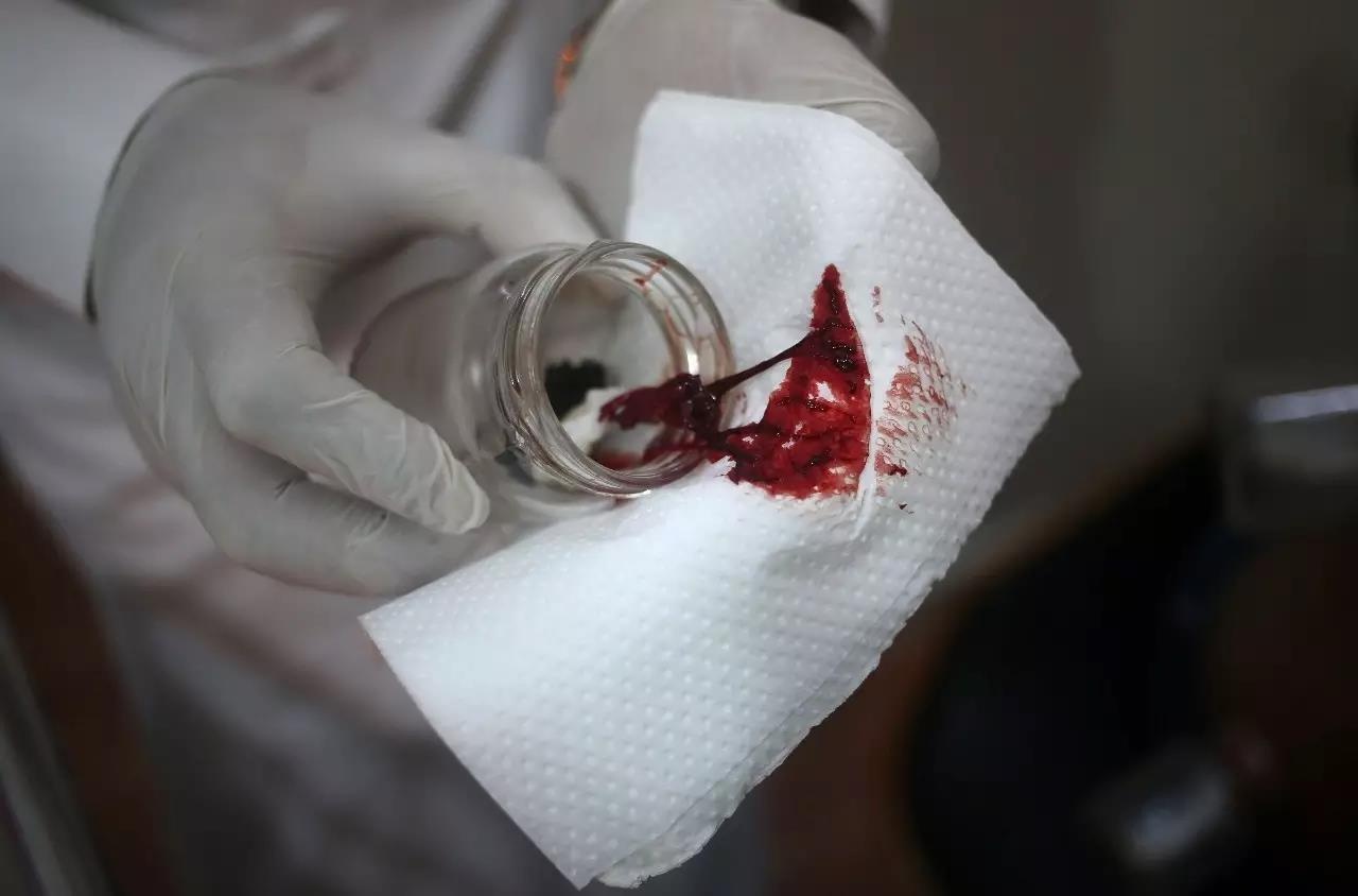 放血疗法,命都给你放没了