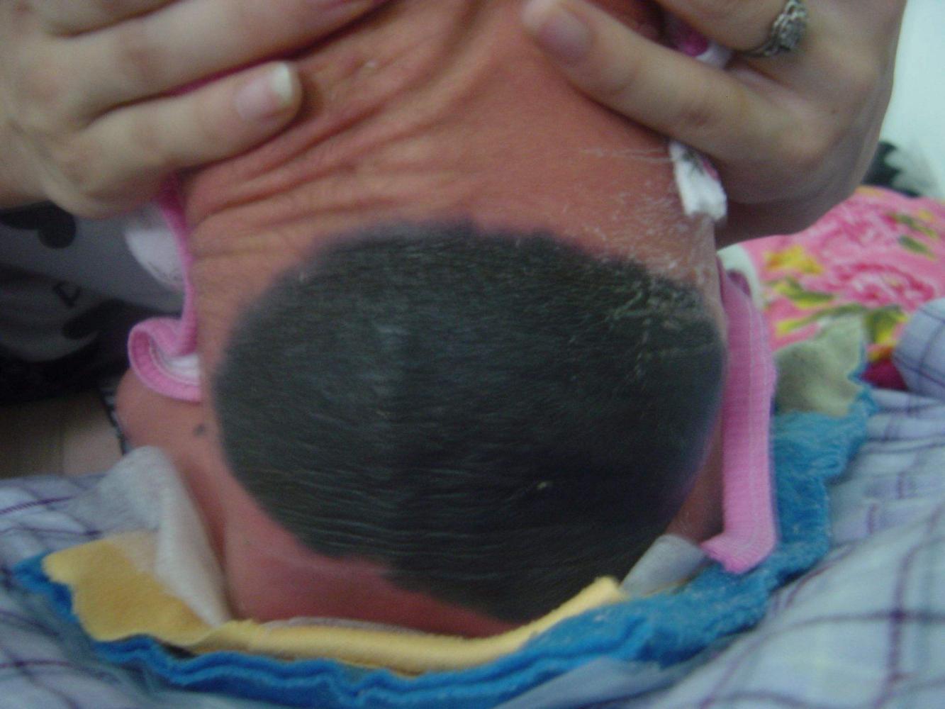 父母因孩子胎记而离婚准妈妈孕期多注意这几点宝宝健康无胎记