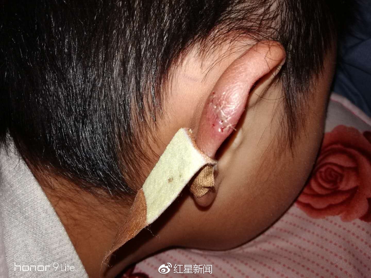理发师一回头 剪刀伤了小勇耳朵