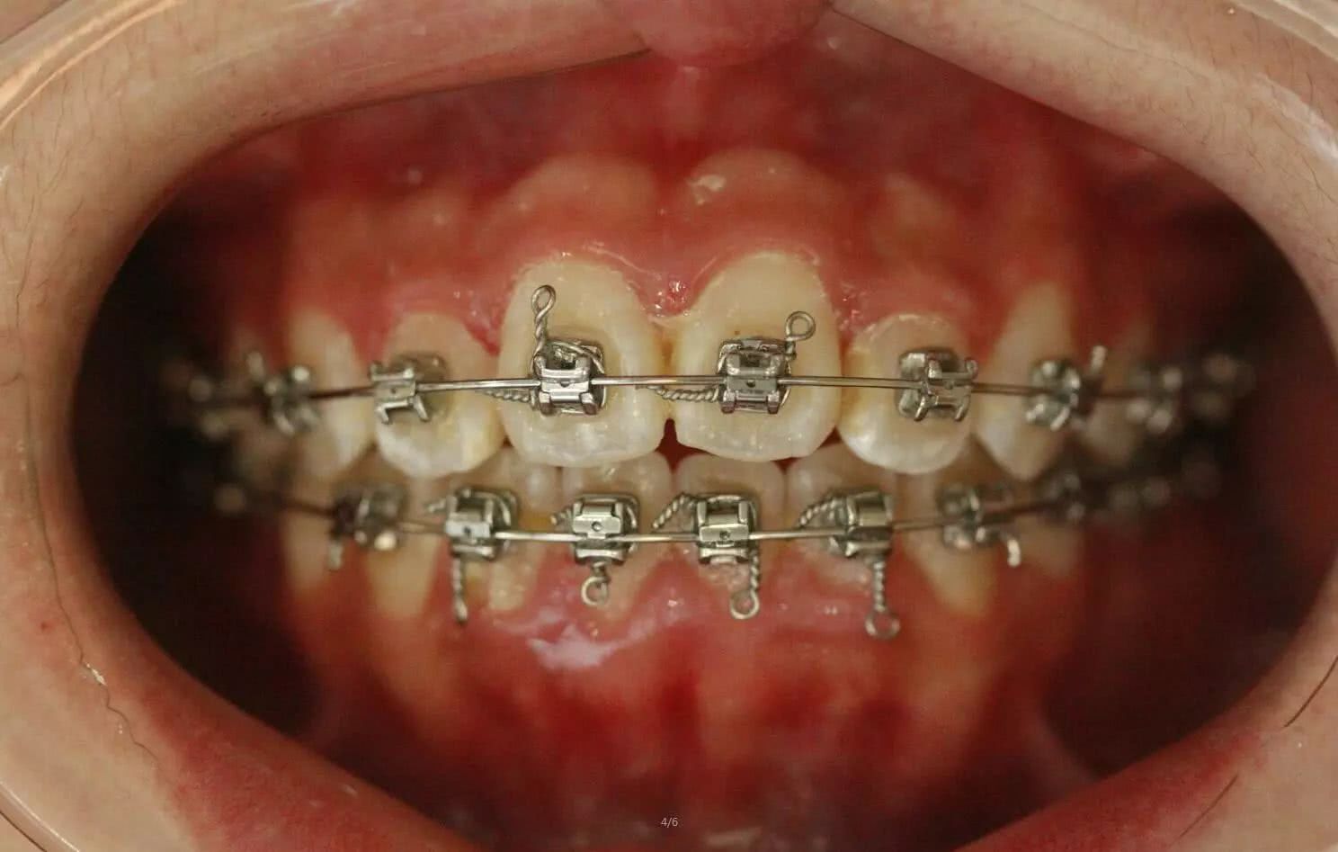 门牙过大二次矫正咬合非常不正常